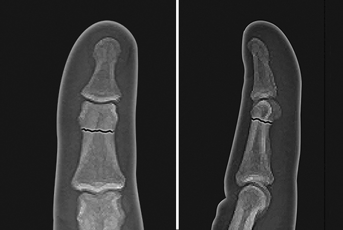 Non-displaced middle phalanx neck fracture