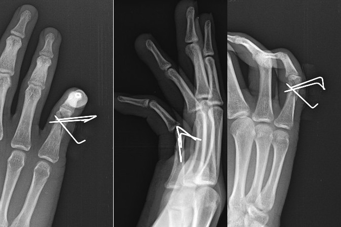 Little finger proximal phalanx radial condylar fracture after closed reduction and pinning