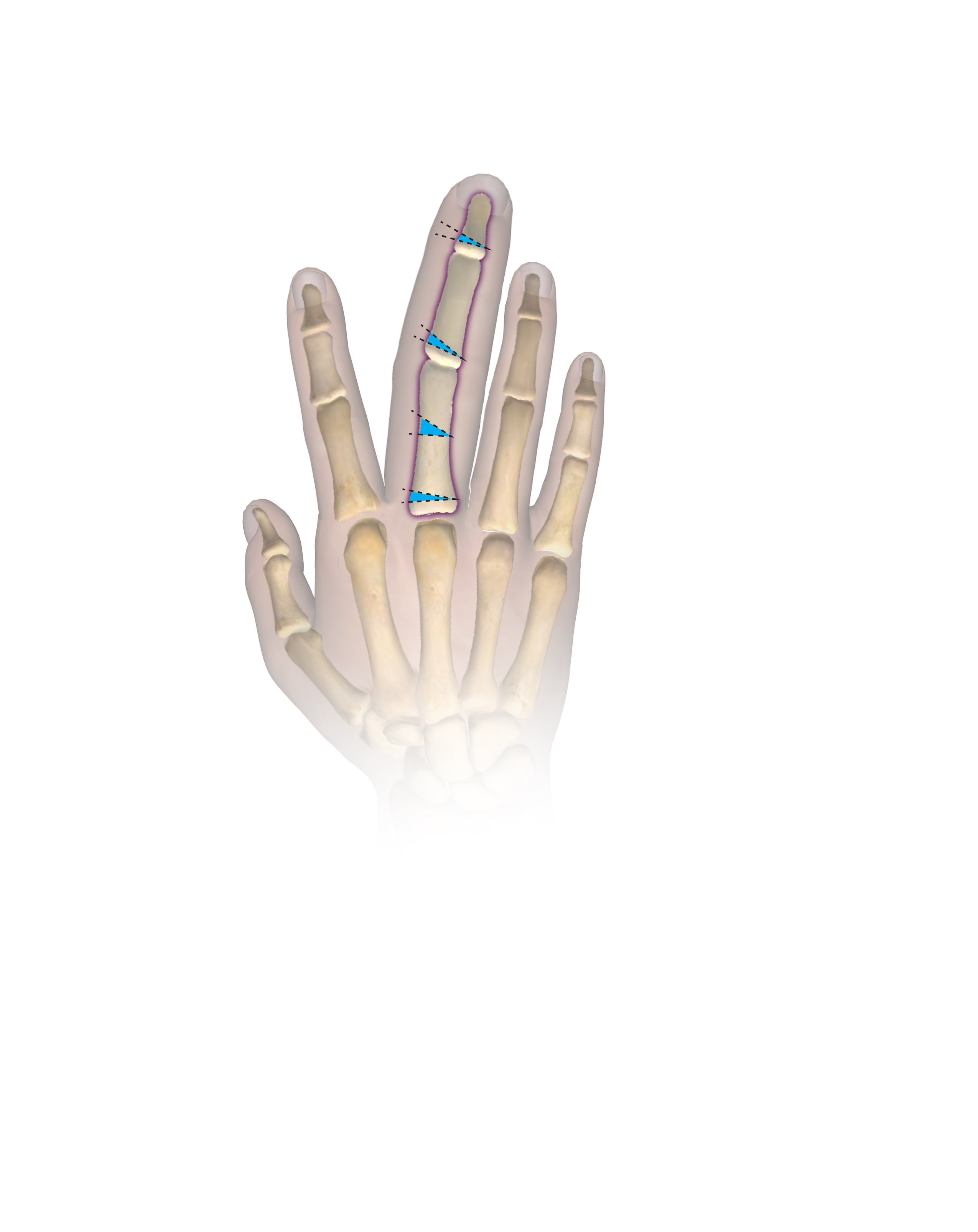 Figure 3A Combined epiphysiodesis and osteotomy to slow growth and correct angulatory deformity of the right long finger.