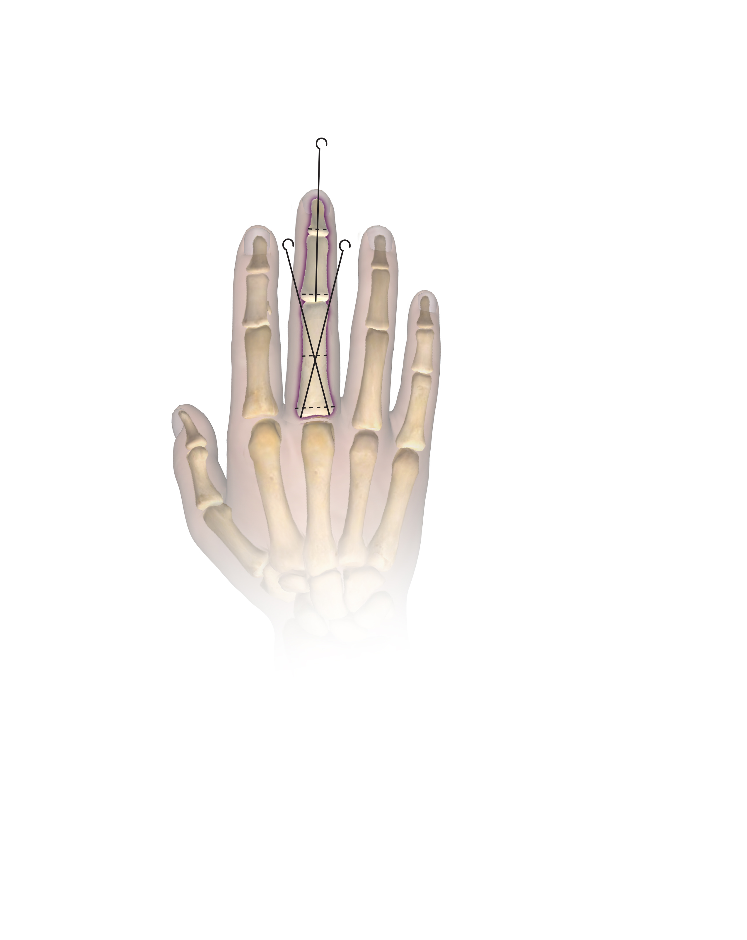 Figure 3B Combined epiphysiodesis and osteotomy to slow growth and correct angulatory deformity of the right long finger.