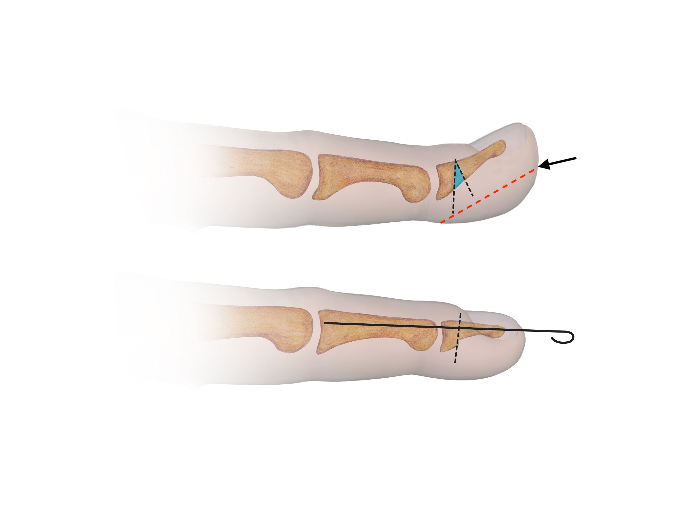 Figure 4 Use volar oblique incision (arrow) which will avoid DIP joint scar related flexion contracture to remove a volar wedge of tissue to debulk the pulp.  Protect the terminal digital arteries and nerves during debulking. Use the same incision to perform a closing wedge osteotomy of the distal phalanx to shorten and straighten the distal phalanx.