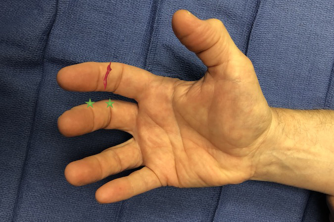 Palmar laceration over neck of the index middle phalanx. Structures at Risk: 1. Skin; 2.Tendon - FDP; 3. Digital Nerves; 4. Digital Arteries; 5. Bone; 6. Possibly DIP Joint. Note green stars at dorsal end of flexion creases.  The neurovascular bundle is immediately volar to these stars. (Click on structure to see exam)