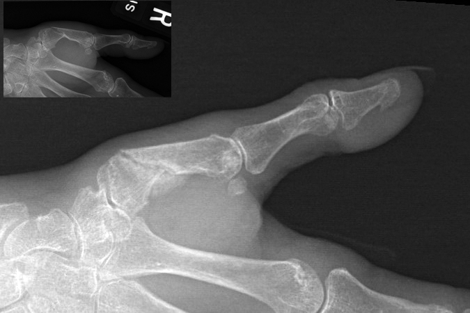 Fracture of base of first metacarpal treated in splint only. Patient has no pain and no functional complaints.