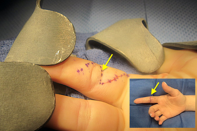Right index FDP and FDS lacerations (arrow) with incision outlined for repair