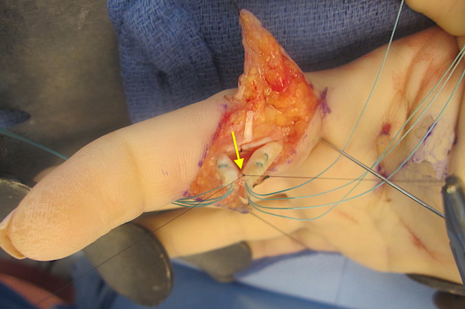 Dorsal peripheral edge suture (arrow) being placed before core sutures tied