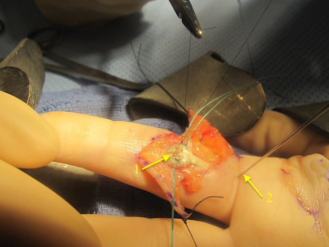 Core suture tied but not cut completely. Volar edge suture (6O nylon) being placed (1).  Needle (2) blocking FDP retraction still in place