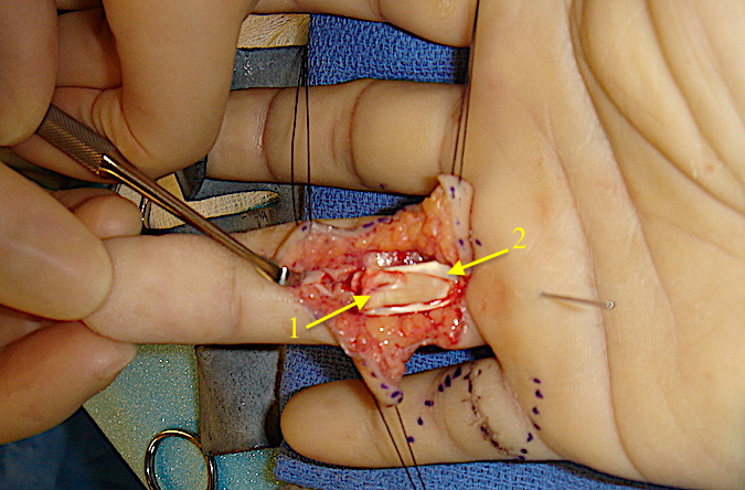 Ringer finger FDS & FDP laceration.  FDP (1) has been retrieved and brought through FDS slips forming the chiasma of Camper (2)