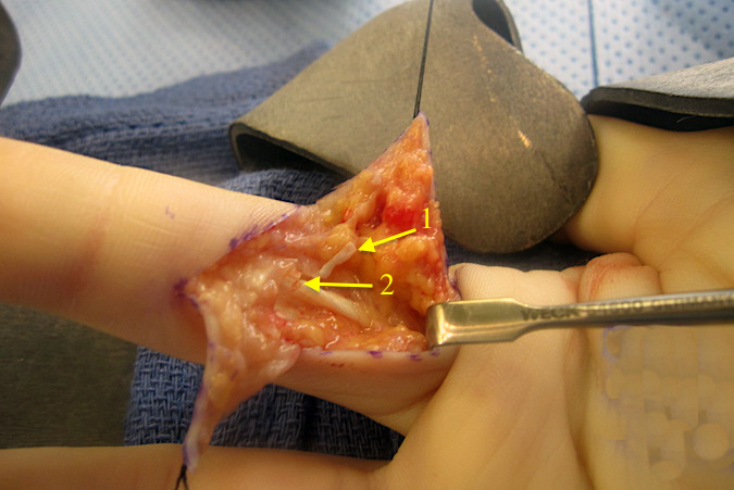 Right index FDP and FDS lacerations with incision open. A slip of cruciate pulley is seen (1) and partial laceration of FDS noted (2)
