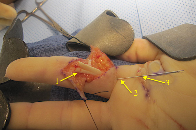 Right index FDP (1) has been retrieved and needle is preventing FDP retraction (2).  Palm incision (3) was used to assist FPD retrieval