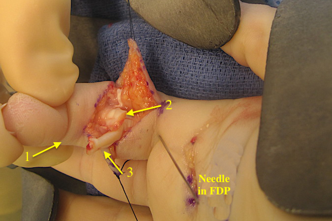 DIP passively flexed to express the distal FDP (2) into the surgical site.  Proximal FDP (3)