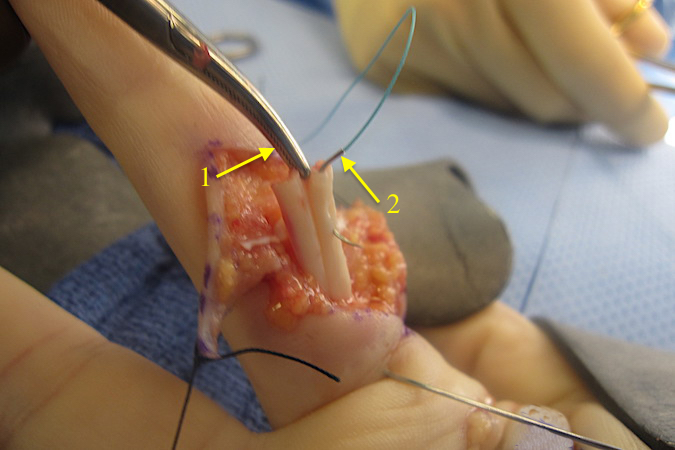 Tiny clamp (1) gently holding proximal FDP so tendon will not have to be grasped repeatedly with a forceps.  Tapered needle with braided permanent 3O suture (2) has been placed in the radial aspect of the FDP tendon.  This the first core suture pass for a modified Kessler suture