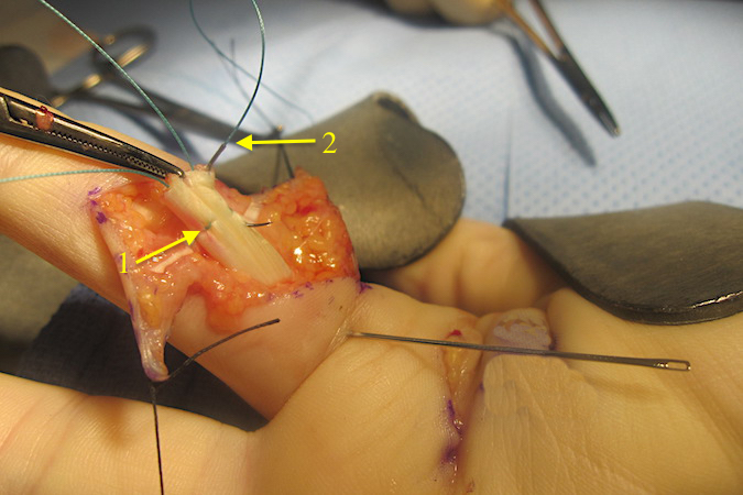 First core suture with a modified Kessler suture is in place (1).  Second core suture (2) being placed in the radial aspect of the FDP tendon.  Second needle placed carefully to avoid damaging the first suture