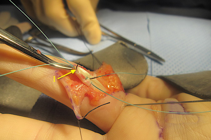  Final pass of the needle for the second core suture (1) being placed in the proximal FDP