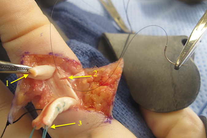 Tiny clamp (1) gently holding distal FDP so tendon will not have to be grasped repeatedly.  Small FDS laceration being tidied up with 6O nylon suture (2).  Modified Kessler core sutures in proximal FDP (3)
