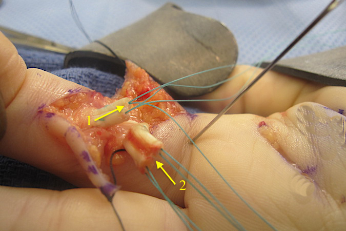 Core sutures in distal FDP (1) and proximal FDP (2)