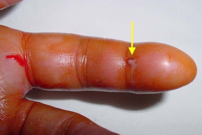 Flexor Tendon Sheath Infection with puncture wound (arrow) and the fourth Kanavel sign: swelling of the entire digit.