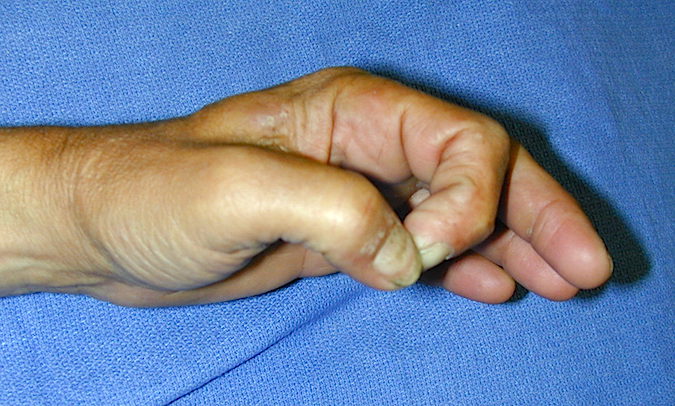 Ulnar Nerve Palsy with positive Froment's sign. Note the flexion of the thumb IP, the index is supported by the other digits and the "O" sign is lost.
