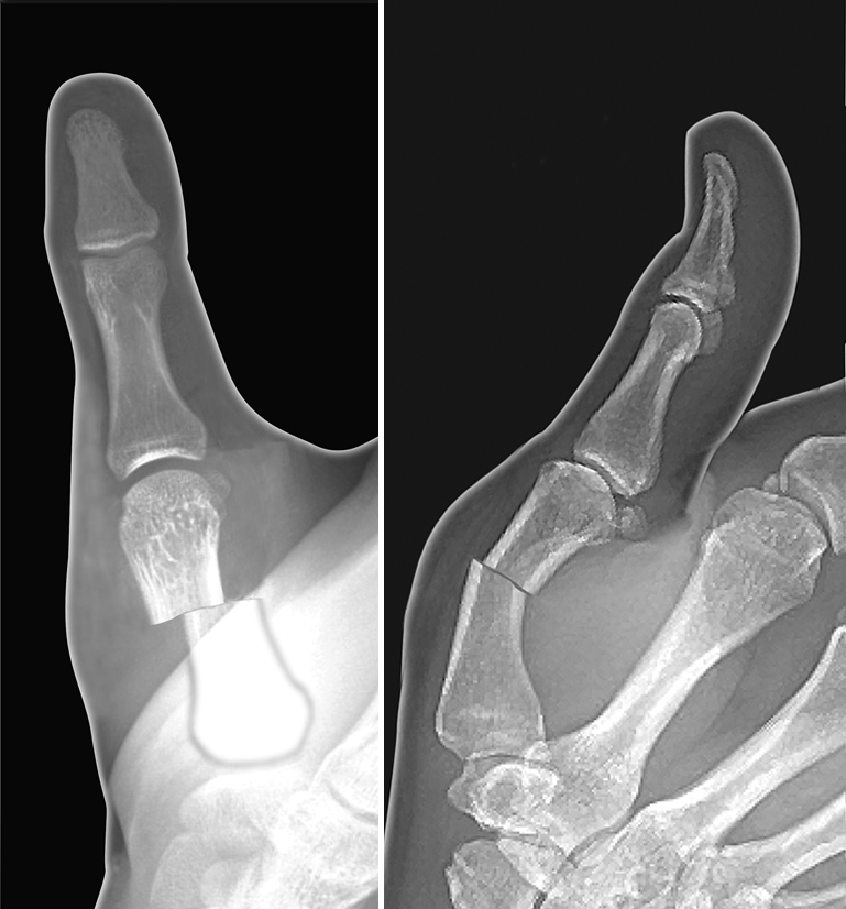 Thumb metacarpal shaft fracture with displacement and angulation