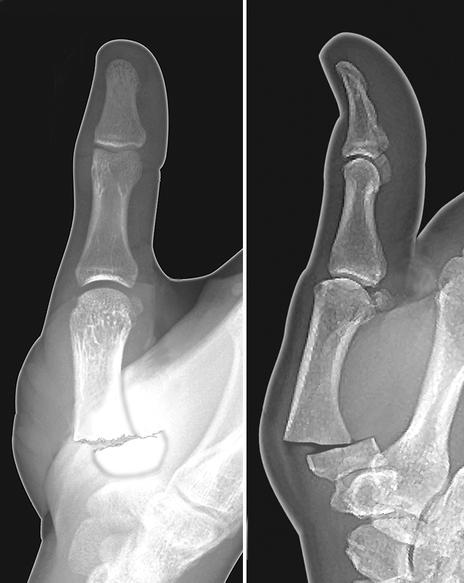 Thumb metacarpal displaced angulated base fracture not involving the joint.