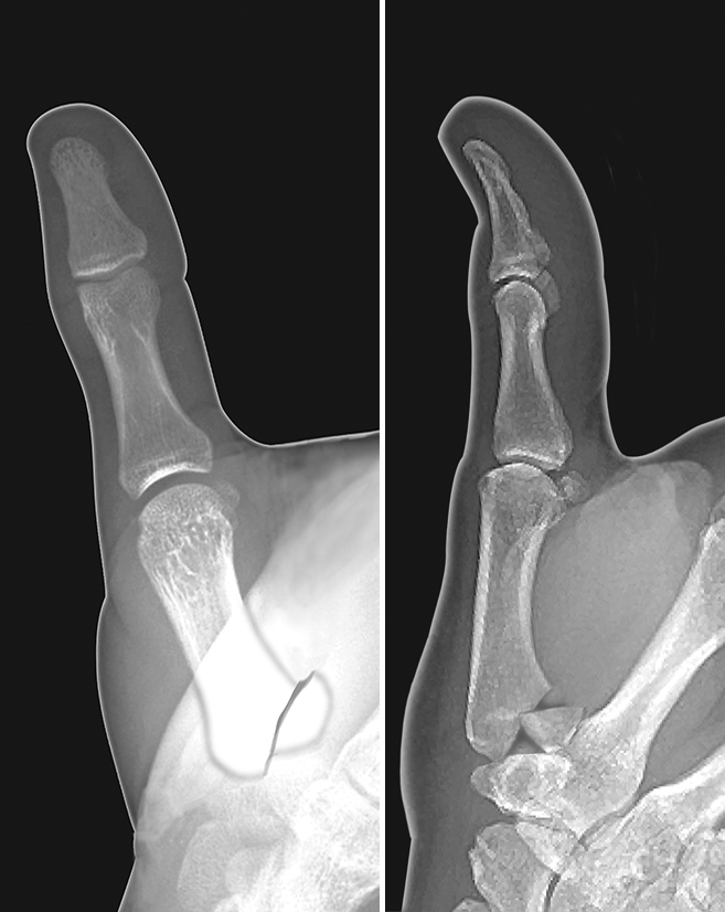 Thumb metacarpal intra-articular displaced angulated base fracture (Bennett's Fracture)