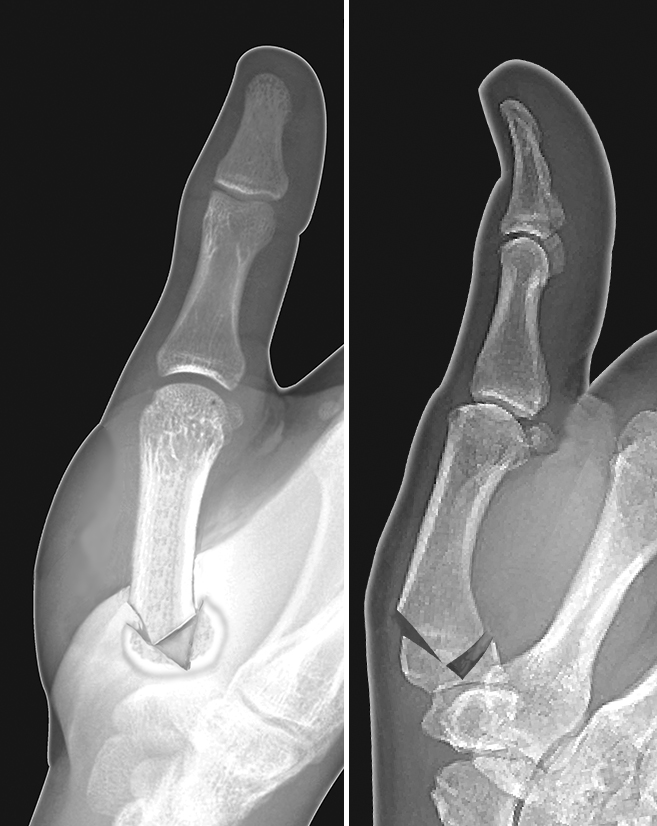 Thumb metacarpal intra-articular displaced comminuted base fracture (Rolando Fracture)