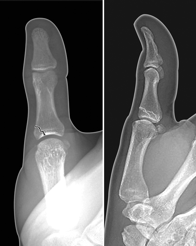 Non-displaced intra-articular thumb proximal phalanx base fracture
