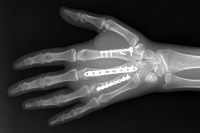  Index, long and ring displaced unstable metacarpal fractures (AP view)after open reduction and internal fixation with plates and screws.