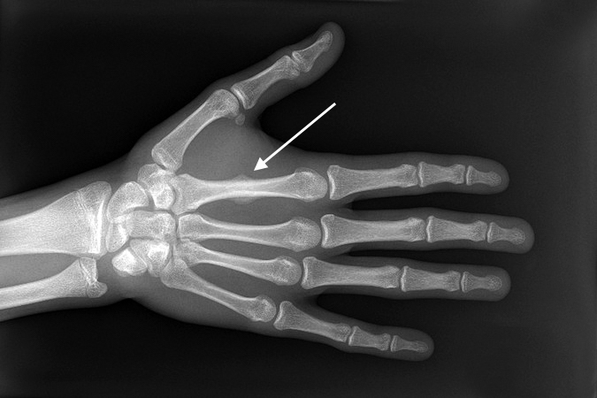 Index transverse non-displaced  metacarpal fracture (arrow) treated in fracture brace.
