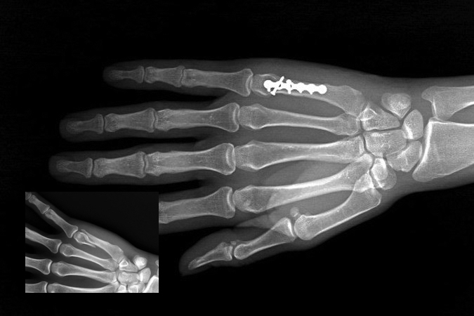  Fifth metacarpal neck/head spiral oblique displaced articular fracture treated with open reduction and internal fixation using intrafragmentary screw and a neutralization plate and screws.