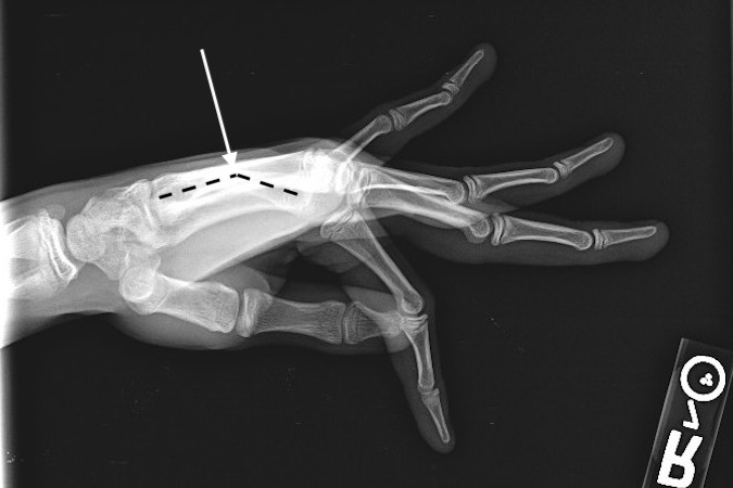 Right fifth transverse mid-shaft metacarpal fracture (arrow). Note typical dorsal apex angulation.