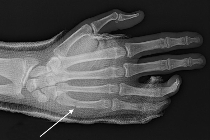 Little metacarpal shaft fracture (arrow) being treated in short arm cast with the base of the ring and little fingers in the cast and the PIP joints free.