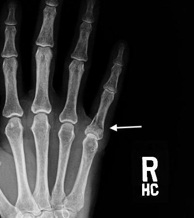 Proximal phalanx angulated base fracture AP