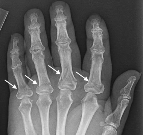 Proximal phalanx base fractures II - V AP