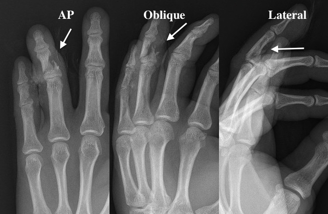 Open middle phalanx shaft fracture with minimal bone loss
