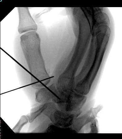 Bennett's fracture treated by CRPP with anatomic joint alignment.
