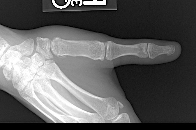 Healed Bennett's fracture treated by CRPP with normal joint congruity.