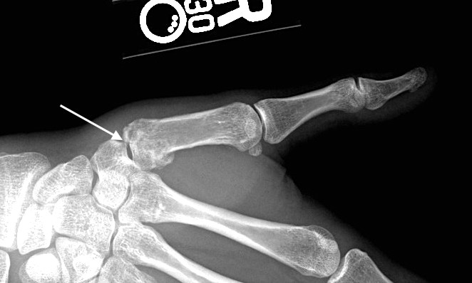 Bennett's fracture (arrow) treated by CRPP with slight residual joint incongruity but no symptoms.
