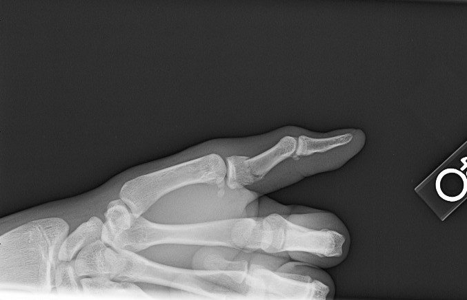 Thumb proximal phalanx angulated base fracture lateral view. Fracture will require closed reduction and cast.