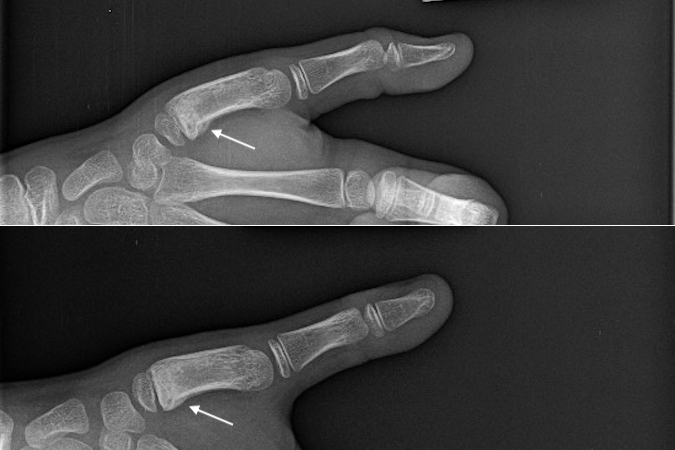 Thumb Metacarpal Pediatric Fracture treated successfully in splint and cast.  Note callus with remodeling (arrow).