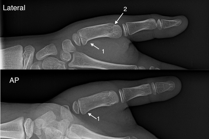 Fracture of the pediatric thumb metacarpal Salter II Lateral (1) and less evident AP fracture line (1) with accessory growth plate visible (2)