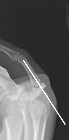 Proximal phalanx angulated base fracture after closed reduction and pinning