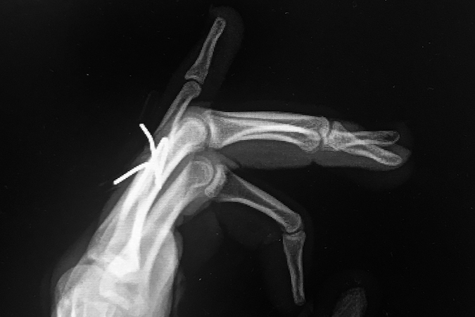 Little finger proximal phalanx bicondylar fracture after closed reduction and pinning lateral
