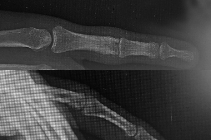 Little finger proximal phalanx bicondylar fracture after pin removal and fracture healing