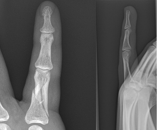 Proximal phalanx comminuted spiral fracture AP & Lateral