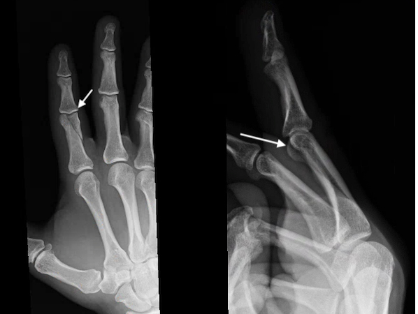 Proximal phalanx radial condyle displaced fracture