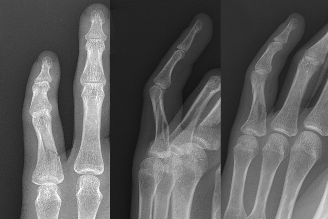 Proximal phalanx fracture comminuted and with volar apex angulation