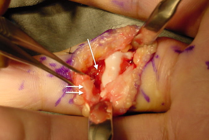Exposure for ORIF - double arrows on fragment & cartilage of middle phalanx and single arrow on shaft fracture surface