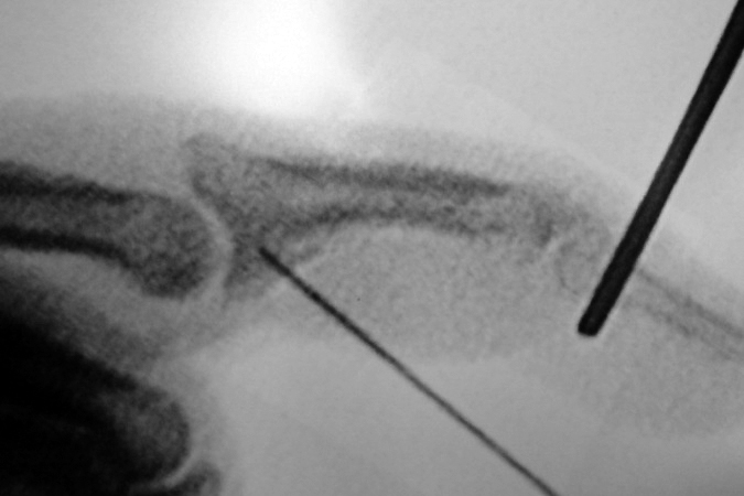 Temporary fixation with K-wire of fracture fragment
