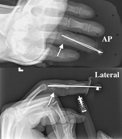 Pinned open middle phalanx shaft fracture