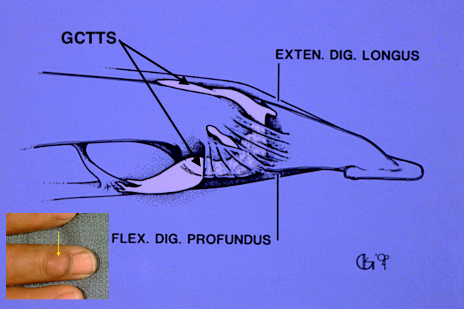 GCTTS invading DIP joint, extensor tendon, collateral ligament and flexor tendon.